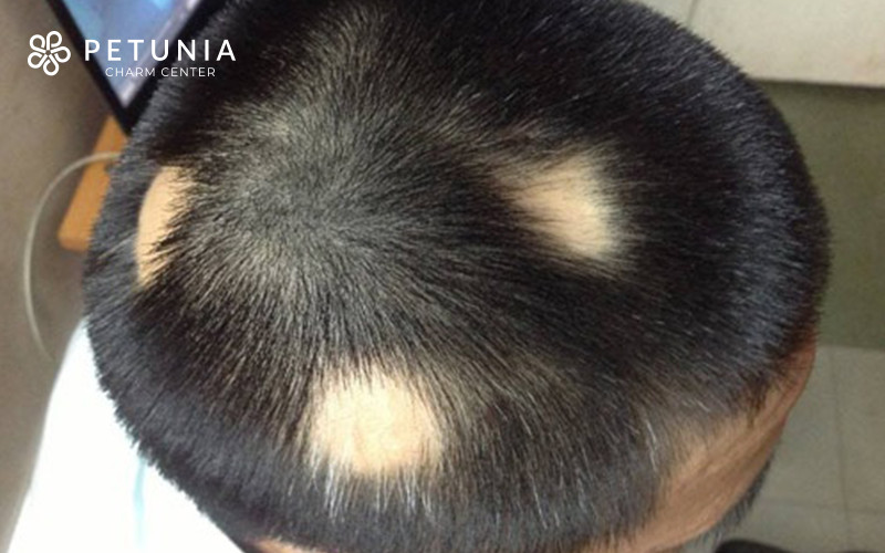 Bệnh lý da đầu là nguyên nhân gây rụng tóc ở nhiều nam giới